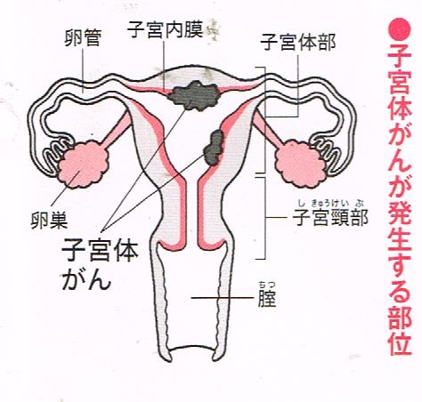 子宮体癌が発生する部位