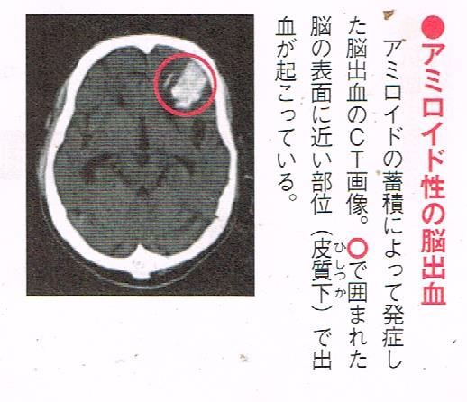 アミロイド性の脳出血