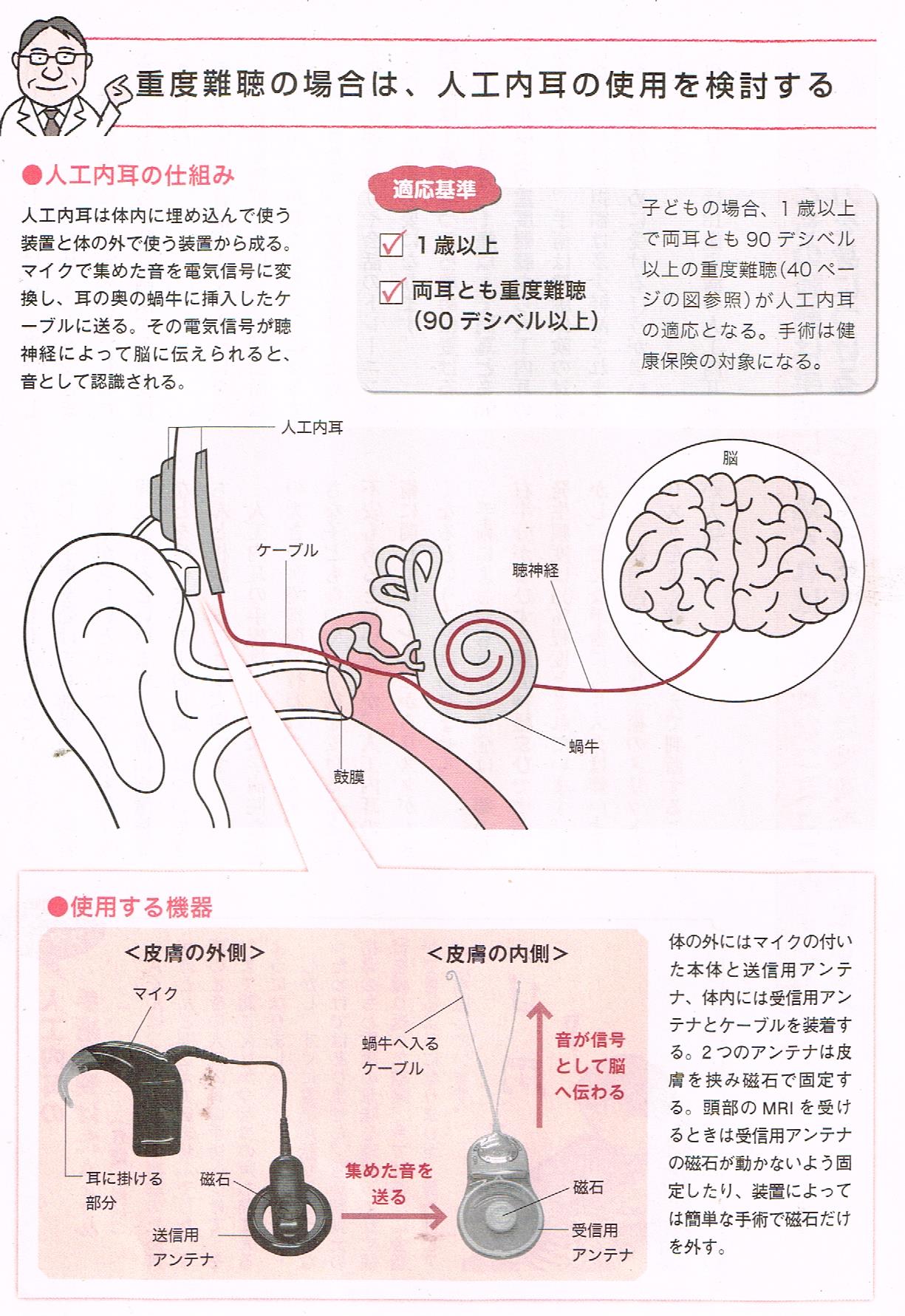 人工内耳の仕組み