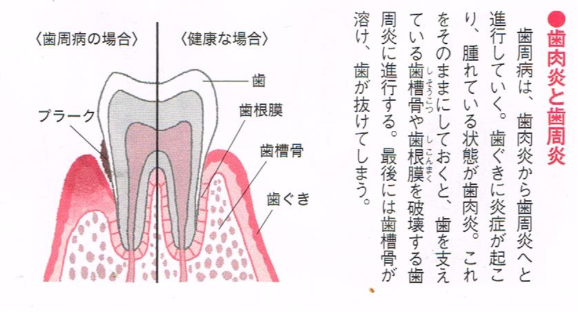 歯肉炎や歯周炎